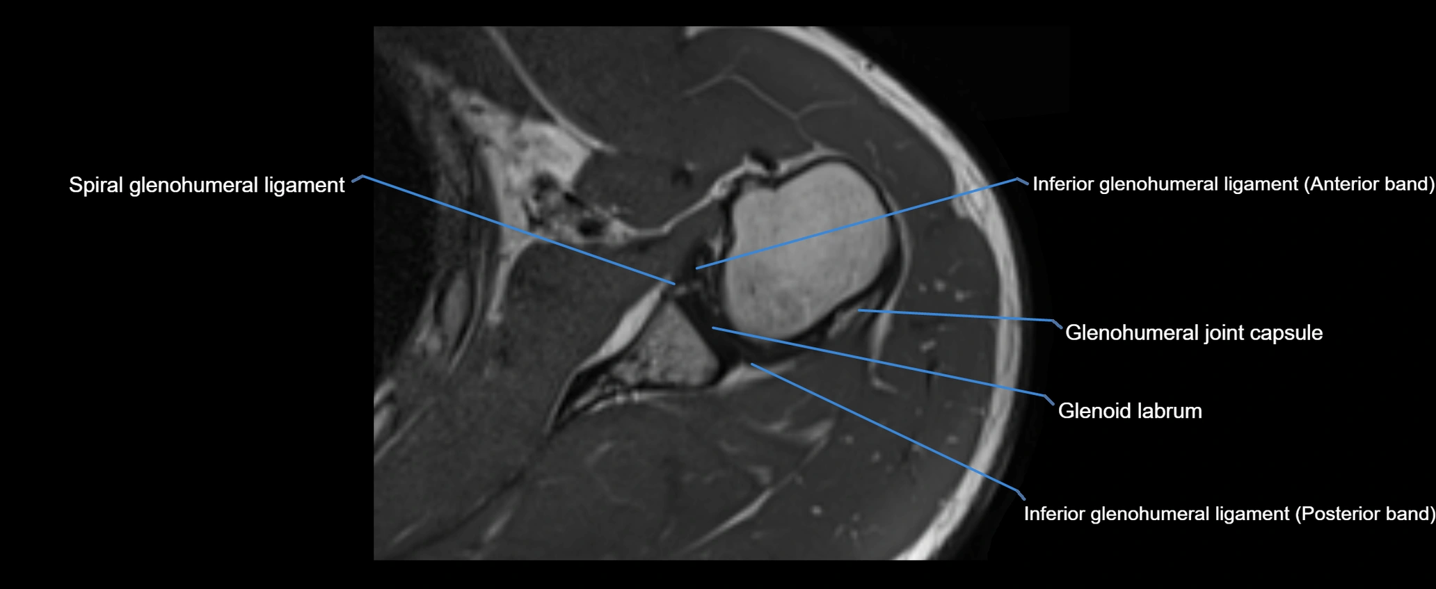 shoulder ligaments axial 3d 3t mri image-img-00005-00080.webp